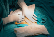 How Long Do C-Section Staples Stay In